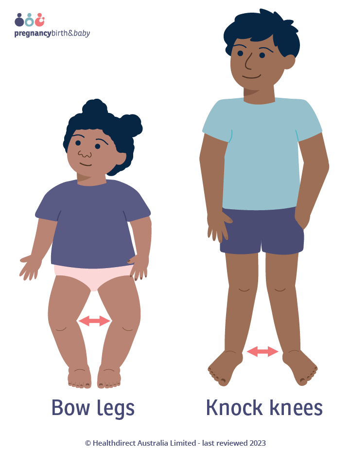 Bow legs and knock knees in children Illustration of a child with bow legs standing next to an older child with knock knees.