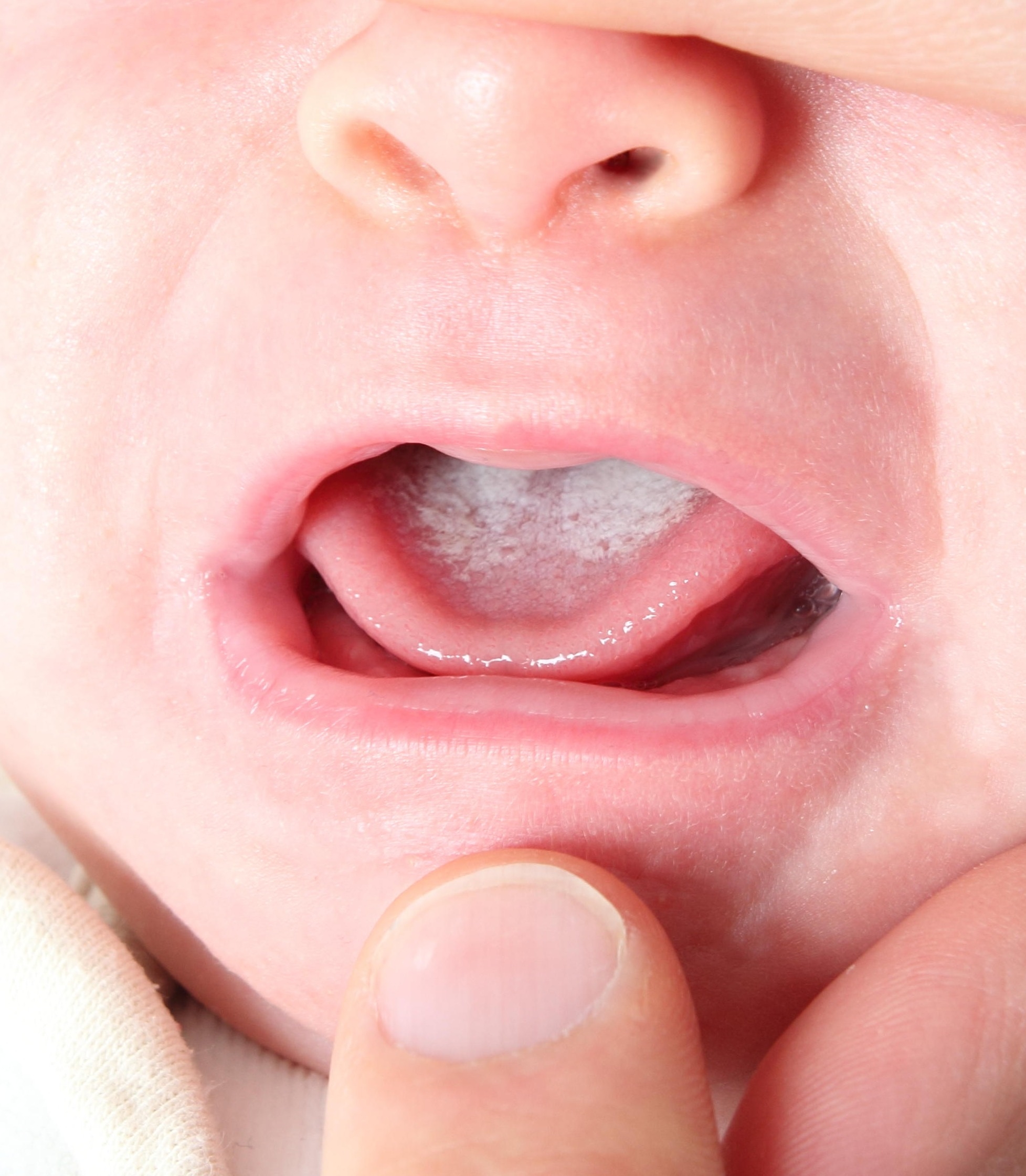 Oral thrush in babies and children Image of a baby with oral thrush. Their mouth is gently held open, so you can see milky, white patches on the tongue.