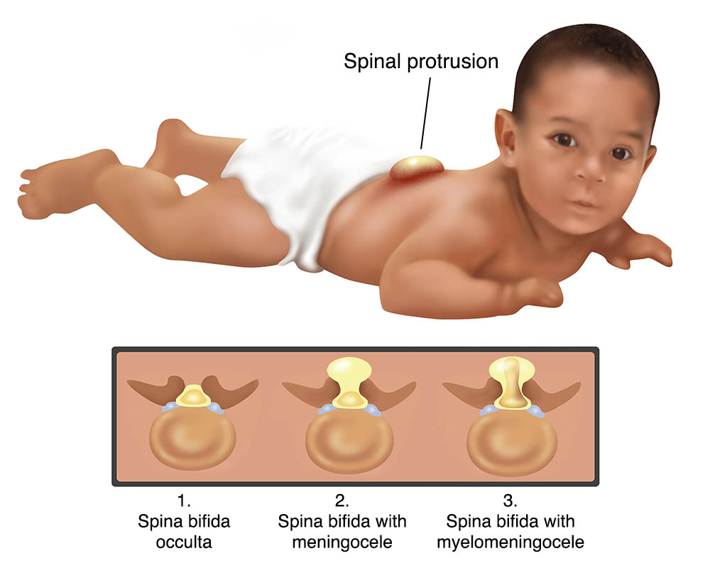 Spina bifida Illustration showing different types of spina bifida.