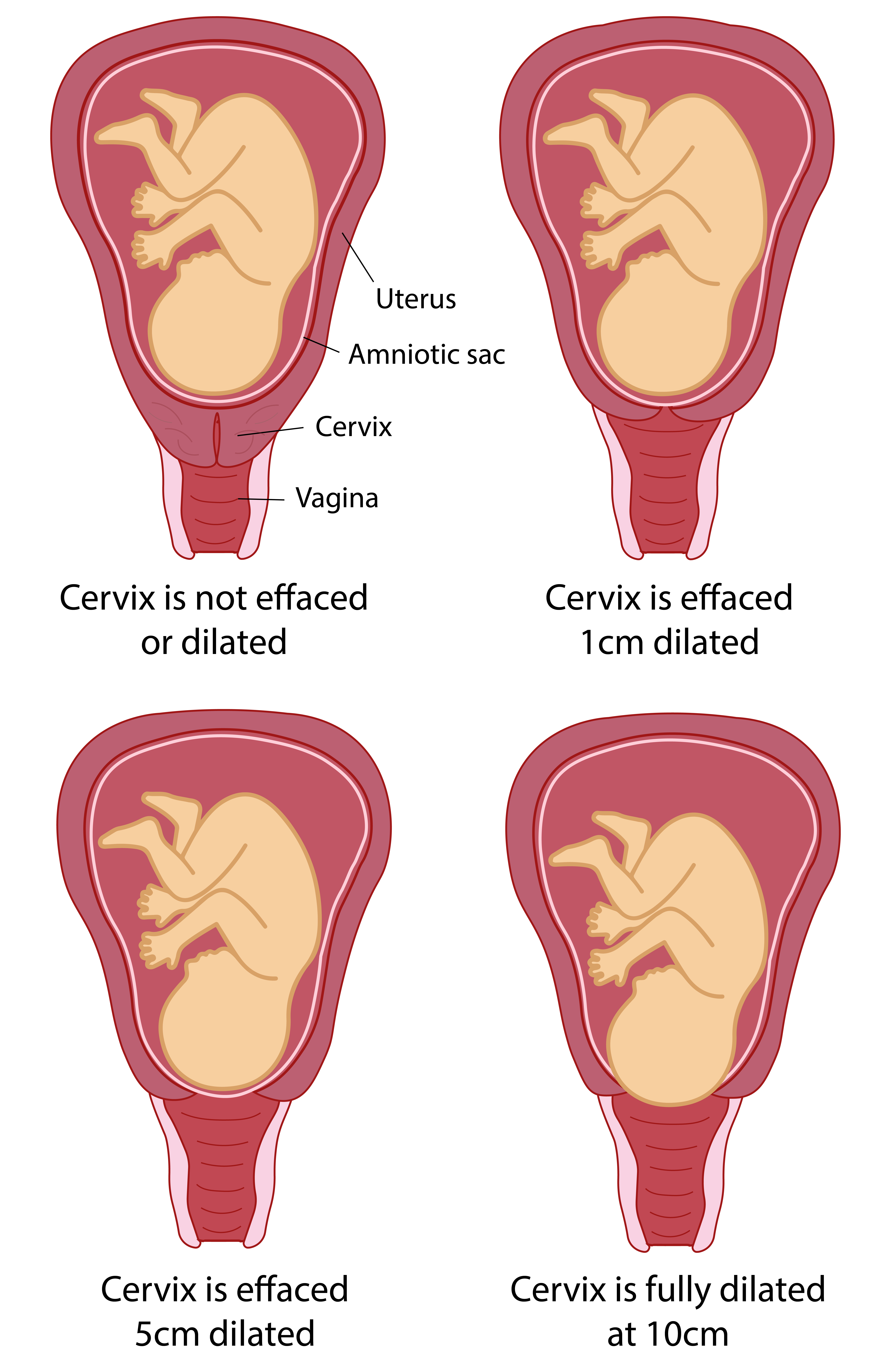 Cervix during labour Illustration showing how the cervix dilates during labour.