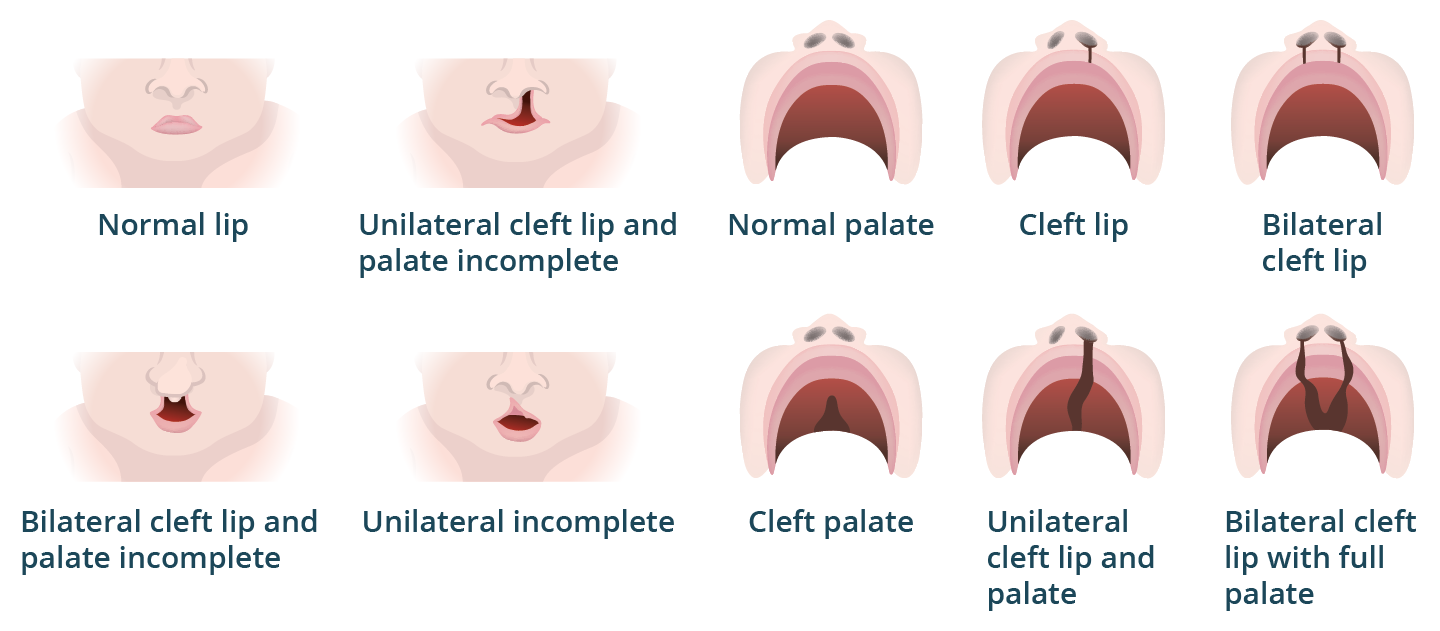 The different types of cleft lip and cleft palate Image showing the various forms of cleft lip and cleft palate in a baby, with views from both the front of the face and inside the mouth.