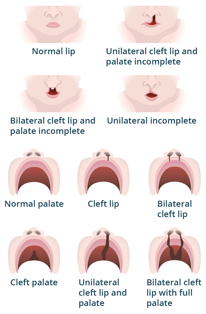 The different types of cleft lip and cleft palate Image showing the various forms of cleft lip and cleft palate in a baby, with views from both the front of the face and inside the mouth.