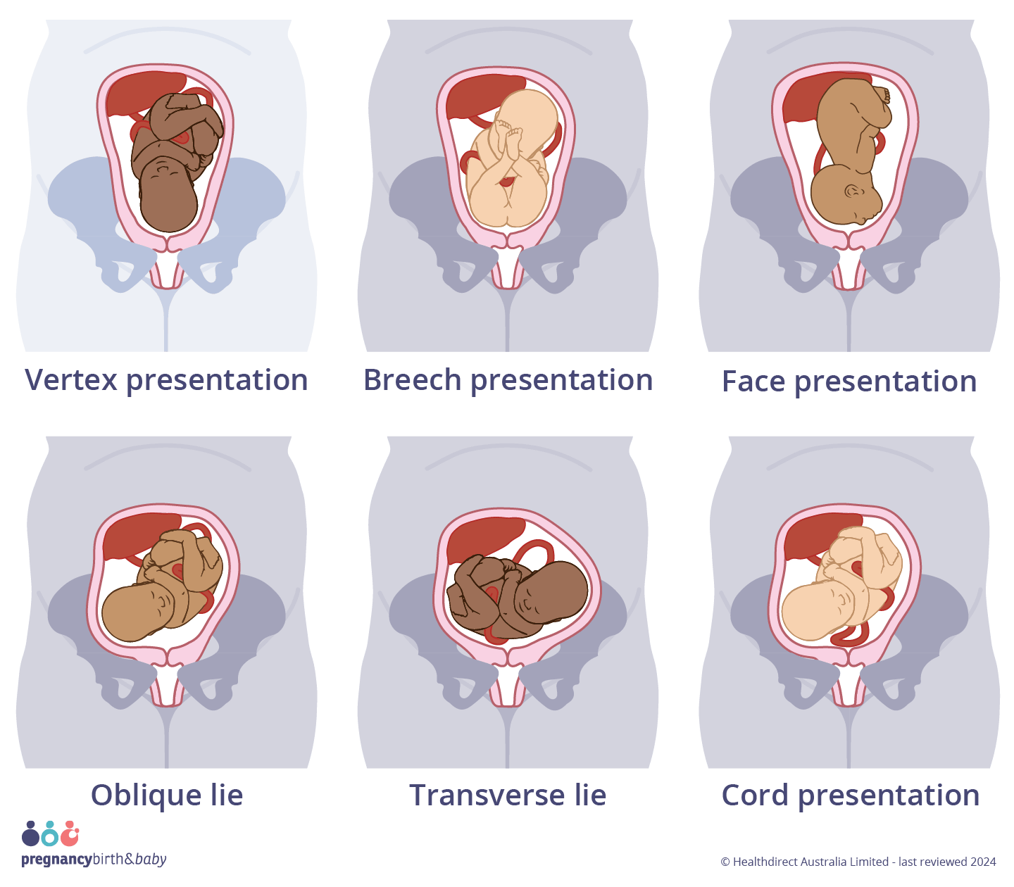 Malpresentation Illustration of ideal presentation (vertex presentation, head-first) and malpresentations; Breech, face, transverse, oblique lie and cord presentation.