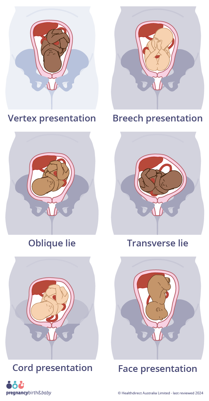 Malpresentation Illustration of ideal presentation (vertex presentation, head-first) and malpresentations; Breech, face, transverse, oblique lie and cord presentation.