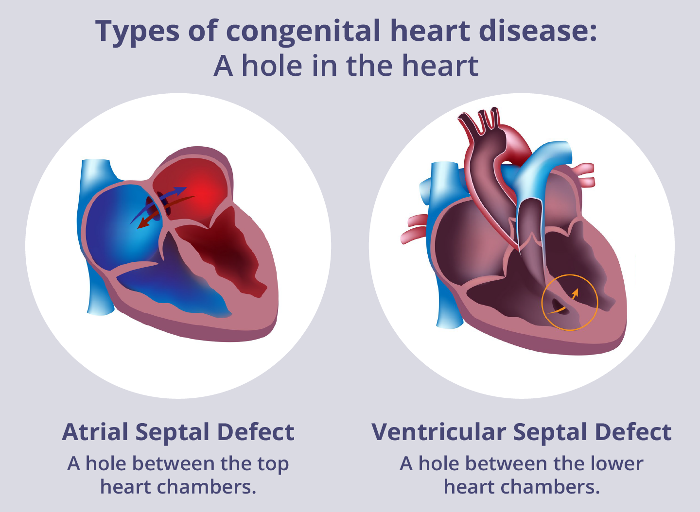 Types of congenital heart disease: a hole in the heart Examples of a hole in the heart. Image on the left shows an atrial septal defect: a hole between the top heart chambers. Image on the right shows a ventricular septal defect: a hole between the lower heart chambers.