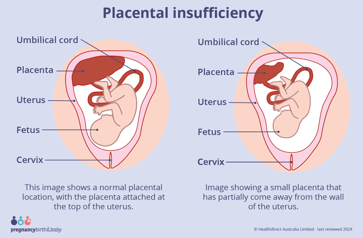 placenta insufficiency Image showing a small placenta that has partially come away from the wall of the uterus.