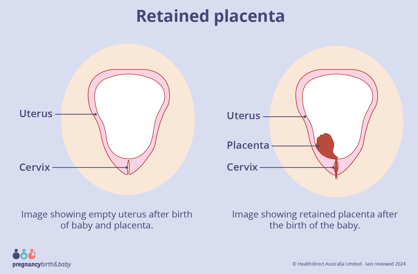 Retained placenta Image showing retained placenta after the birth of the baby.