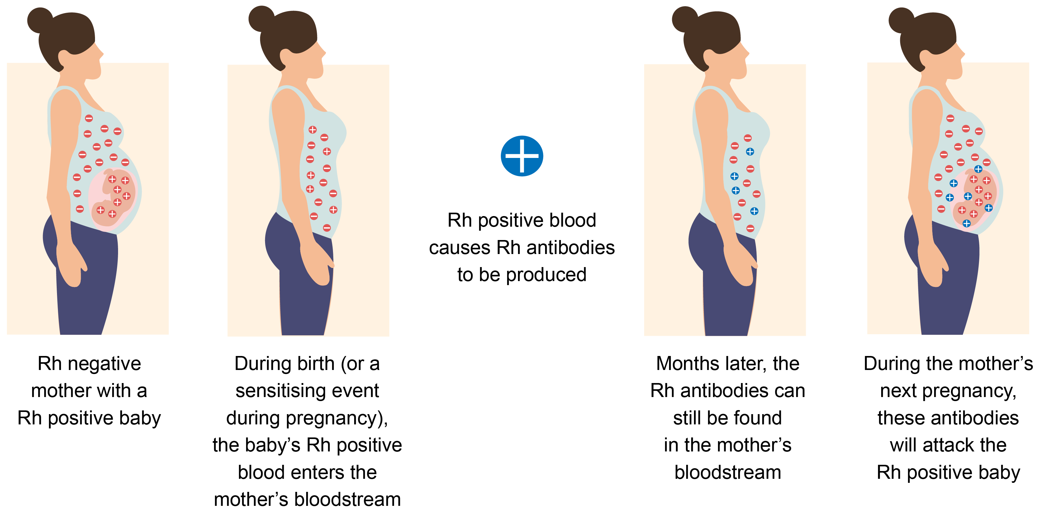 Illustration showing how haemolytic disease of the newborn can occur Illustration showing how haemolytic disease of the newborn can occur.