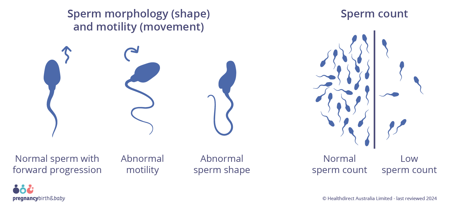 Sperm Health Infographic on sperm health, showing examples of normal sperm movement (forward spiraling like a cork screw) and abnormal movement (zig zagging or circling in on itself), normal sperm shape (oval head with a long tail) and an abnormal shape (head or tail defects). Along with a side by side comparison of normal sperm count (at least 15million sperm per mL) and low sperm count.