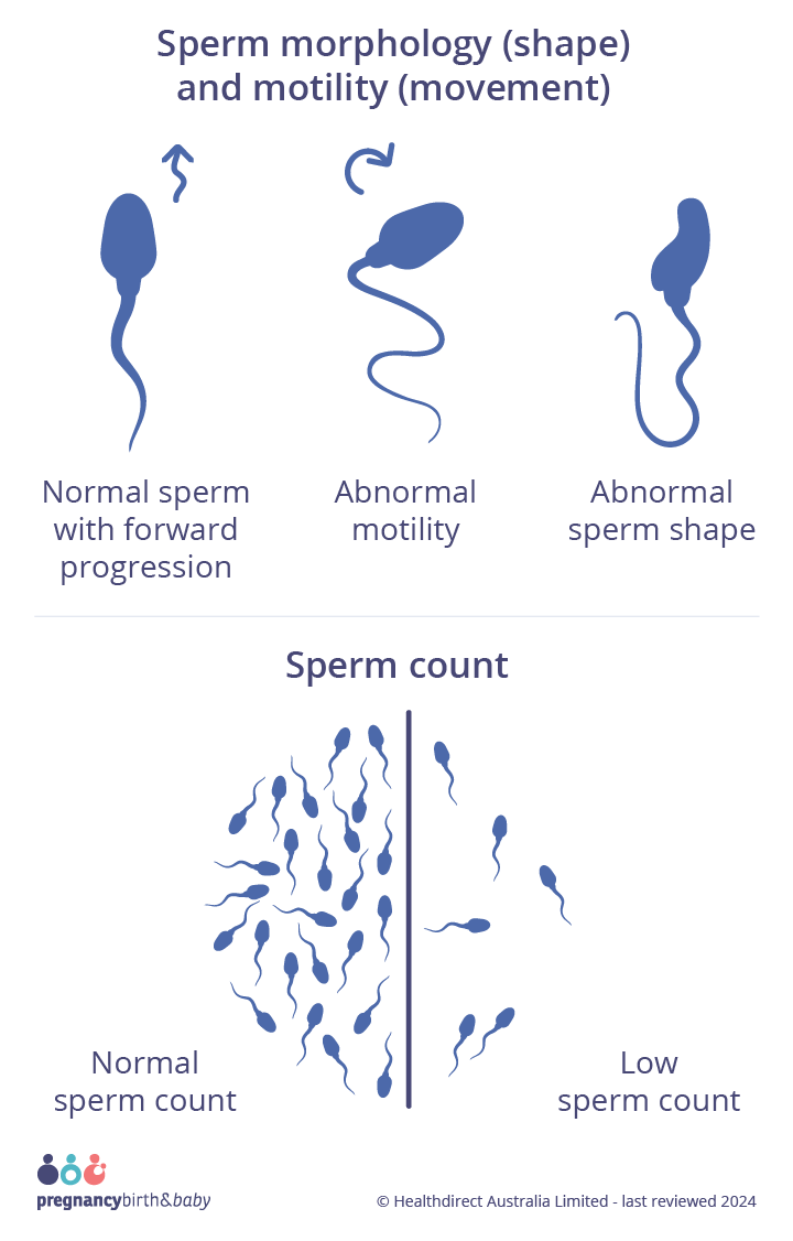 Sperm Health Infographic on sperm health, showing examples of normal sperm movement (forward spiraling like a cork screw) and abnormal movement (zig zagging or circling in on itself), normal sperm shape (oval head with a long tail) and an abnormal shape (head or tail defects). Along with a side by side comparison of normal sperm count (at least 15million sperm per mL) and low sperm count.